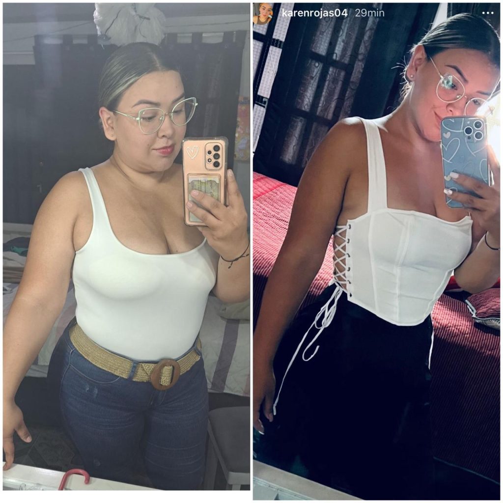 Antes y Después Cirugía Bariátrica Colombia