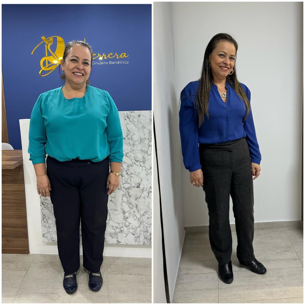 Antes y Después Cirugía Bariátrica Colombia