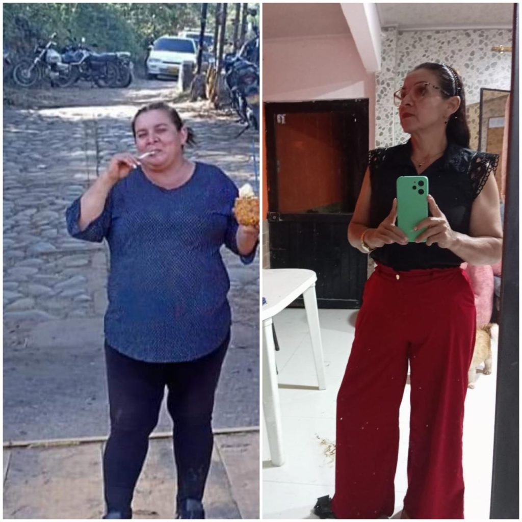 Antes y Después Cirugía Bariátrica Colombia